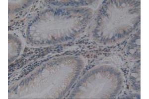 IHC-P analysis of Human Rectum Cancer Tissue, with DAB staining. (Angiotensin I Converting Enzyme 1 anticorps  (AA 1160-1306))