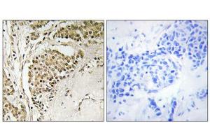 Immunohistochemistry analysis of paraffin-embedded human breast carcinoma tissue using NOM1 antibody.