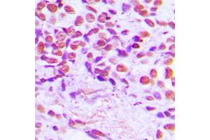 Immunohistochemical analysis of SENP3 staining in human breast cancer formalin fixed paraffin embedded tissue section.