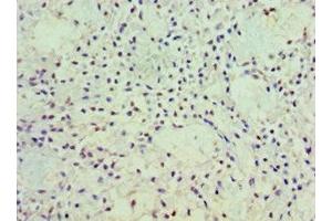 Immunohistochemistry of paraffin-embedded human breast cancer using ABIN7162919 at dilution of 1:100 (Periostin anticorps  (AA 557-836))