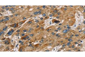Immunohistochemistry of paraffin-embedded Human liver cancer using SULT1B1 Polyclonal Antibody at dilution of 1:30 (SULT1B1 anticorps)