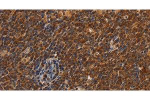 Immunohistochemistry of paraffin-embedded Human Lymphoma using CDC34 Polyclonal Antibody at dilution of 1:50