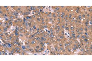 Immunohistochemistry of paraffin-embedded Human liver cancer tissue using GCSAM Polyclonal Antibody at dilution 1:40 (GCET2 anticorps)