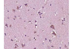Paraformaldehyde-fixed, paraffin embedded human brain glioma; Antigen retrieval by boiling in sodium citrate buffer (pH6) for 15min; Block endogenous peroxidase by 3% hydrogen peroxide for 30 minutes; Blocking buffer (normal goat serum) at 37°C for 20min; Antibody incubation with YKL39/CHI3L2 Polyclonal Antibody, Unconjugated (bs-1238R) at 1:200 overnight at 4°C, followed by a conjugated secondary and DAB staining. (CHI3L2 anticorps  (AA 121-220))
