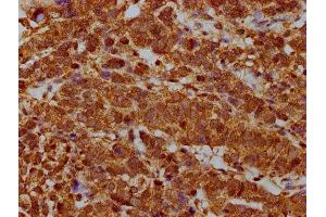 IHC image of ABIN7168131 diluted at 1:400 and staining in paraffin-embedded human ovarian cancer performed on a Leica BondTM system. (RPP38 anticorps  (AA 210-283))