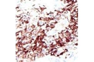 Formalin-fixed and paraffin-embedded human cancer tissue reacted with the primary antibody, which was peroxidase-conjugated to the secondary antibody, followed by DAB staining.