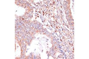 Immunohistochemistry of paraffin-embedded human colon carcinoma using C antibody (ABIN7266010) at dilution of 1:100 (40x lens).