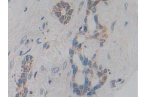 Detection of CYP21A2 in Human Bile duct cancer Tissue using Polyclonal Antibody to Cytochrome P450 Family 21 Subfamily A Member 2 (CYP21A2)