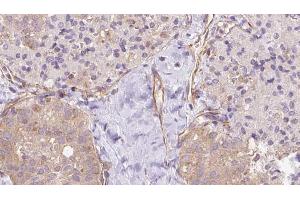 ABIN6273337 at 1/100 staining Human thyroid cancer tissue by IHC-P. (UBE2E2 anticorps  (N-Term))