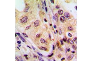 Immunohistochemical analysis of B-RAF staining in human liver cancer formalin fixed paraffin embedded tissue section.