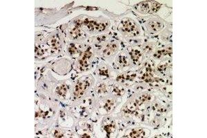 Immunohistochemical analysis of CREB (pS129) staining in human breast cancer formalin fixed paraffin embedded tissue section.