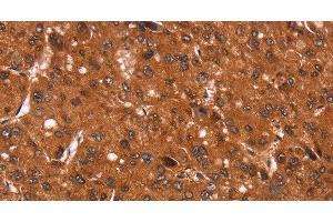 Immunohistochemistry of paraffin-embedded Human liver cancer tissue using Cyclin D3 Polyclonal Antibody at dilution 1:40 (Cyclin D3 anticorps)
