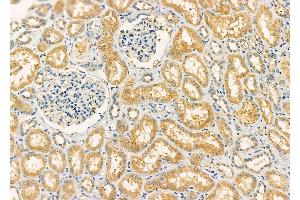 ABIN6261230 and ABIN6277319 at 1/100 staining Human kidney cancer and adjacent normal tissues by IHC-P. (DBH anticorps  (Internal Region))