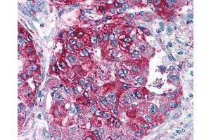 Anti-NPY5R antibody IHC of human Lung, Adenocarcinoma. (NPY5R anticorps  (Cytoplasmic Domain))