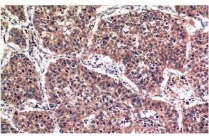 Immunohistochemistry of paraffin-embedded Human lung carcinoma tissue using Phospho-AKT1 (Ser473) Monoclonal Antibody at dilution of 1:200 (AKT1 anticorps  (pSer473))