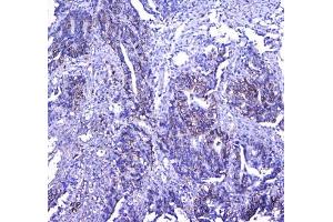 IHC testing of FFPE human rectal cancer tissue with CD41 antibody at 1ug/ml. (Integrin Alpha2b anticorps)