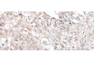 Immunohistochemistry of paraffin-embedded Human lung cancer tissue using VRK3 Polyclonal Antibody at dilution of 1:45(x200) (VRK3 anticorps)