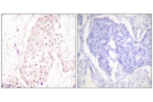 Immunohistochemistry analysis of paraffin-embedded human breast carcinoma tissue using SENP8 antibody. (SENP8 anticorps  (C-Term))