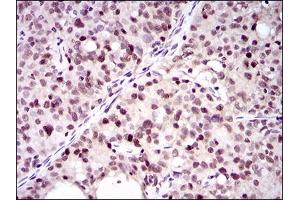 Immunohistochemical analysis of paraffin-embedded cervical cancer tissues using PCNA mouse mAb with DAB staining. (PCNA anticorps  (AA 53-196))