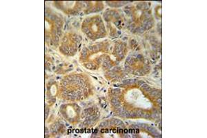 CRABP1 Antibody immunohistochemistry analysis in formalin fixed and paraffin embedded human prostate carcinoma followed by peroxidase conjugation of the secondary antibody and DAB staining.