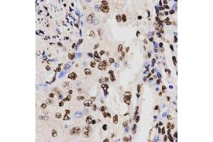 Immunohistochemistry of paraffin-embedded human lung cancer using DiMethyl-Histone H3-K27 antibody.