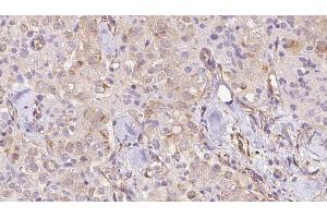 ABIN6273332 at 1/100 staining Human thyroid cancer tissue by IHC-P. (Transmembrane Protein 70 (TMM70) (Internal Region) anticorps)