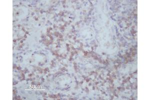 ABIN6266591 at 1/200 staining human Oral squamous cell carcinoma sections by IHC-P.