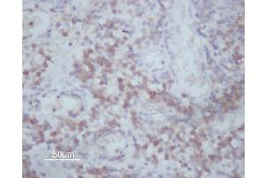 ABIN6266591 at 1/200 staining human Oral squamous cell carcinoma sections by IHC-P. (MMP14 anticorps  (C-Term))