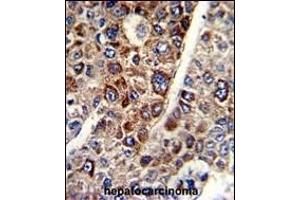 Formalin-fixed and paraffin-embedded human hepatocarcinoma with CD38 Antibody (C-term), which was peroxidase-conjugated to the secondary antibody, followed by DAB staining. (CD38 anticorps  (C-Term))