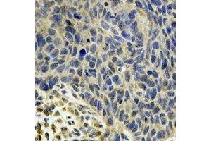 Immunohistochemical analysis of MsrB2 staining in human esophageal cancer formalin fixed paraffin embedded tissue section. (MSRB2 anticorps)