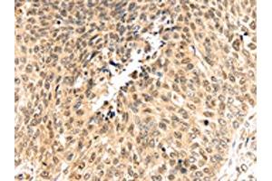 The image on the left is immunohistochemistry of paraffin-embedded Human lung cancer tissue using ABIN7192036(PSMB8 Antibody) at dilution 1/30, on the right is treated with synthetic peptide. (PSMB8 anticorps)