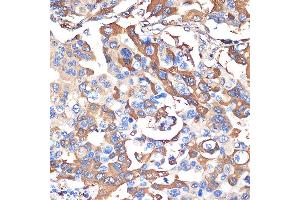 Immunohistochemistry of paraffin-embedded human lung cancer using VPS28 Rabbit mAb (ABIN7271275) at dilution of 1:100 (40x lens).