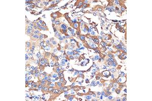 Immunohistochemistry of paraffin-embedded human lung cancer using VPS28 Rabbit mAb (ABIN7271275) at dilution of 1:100 (40x lens). (VPS28 anticorps)