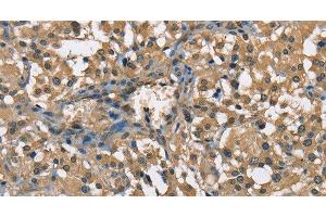 Immunohistochemistry of paraffin-embedded Human thyroid cancer using ENO1 Polyclonal Antibody at dilution of 1:60