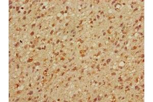 Immunohistochemistry of paraffin-embedded human glioma using ABIN7159613 at dilution of 1:100 (MBD3 anticorps  (AA 79-209))