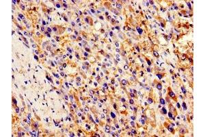 Immunohistochemistry of paraffin-embedded human liver cancer using ABIN7145972 at dilution of 1:100 (CCL2 anticorps  (AA 24-99))