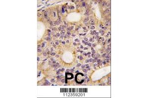 Formalin-fixed and paraffin-embedded human prostata carcinoma tissue reacted with Latexin antibody (N-term), which was peroxidase-conjugated to the secondary antibody, followed by DAB staining.