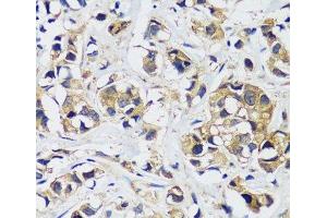 Immunohistochemistry of paraffin-embedded Human breast cancer using CAMLG Polyclonal Antibody at dilution of 1:100 (40x lens).