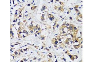 Immunohistochemistry of paraffin-embedded Human breast cancer using CAMLG Polyclonal Antibody at dilution of 1:100 (40x lens). (CAMLG anticorps)