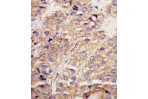 Formalin-fixed and paraffin-embedded human breast carcinoma tissue reacted with hSMURF1-W81 (ABIN388828 and ABIN2850430) , which was peroxidase-conjugated to the secondary antibody, followed by DAB staining.