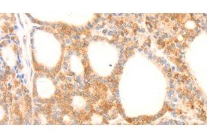 Immunohistochemistry of paraffin-embedded Human thyroid cancer using NAP1L1 Polyclonal Antibody at dilution of 1:70 (NAP1L1 anticorps)