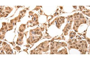 Immunohistochemistry of paraffin-embedded Human breast cancer using ACO2 Polyclonal Antibody at dilution of 1:30 (ACO2 anticorps)