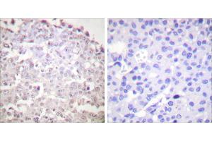 Peptide - +Immunohistochemical analysis of paraffin-embedded human breast carcinoma tissue using GADD153 antibody (#C0202). (DDIT3 anticorps)