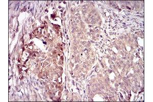 Immunohistochemical analysis of paraffin-embedded cervical cancer tissues using VIL1 mouse mAb with DAB staining. (Villin 1 anticorps  (AA 1-209))