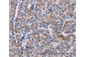 Immunohistochemistry of Human liver cancer using KRT14 Polyclonal Antibody at dilution of 1:20 (KRT14 anticorps)