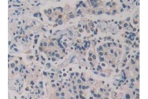 Detection of GR in Human Prostate cancer Tissue using Polyclonal Antibody to Glutathione Reductase (GR)