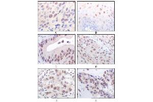 Immunohistochemical analysis of paraffin-embedded human esophageal squamous cell carcinoma (A), normal esophagus epithelium (B), rectum adenocarcinoma (C), lung squamous cell carcinoma (D), breast infiltrating carcinoma (E), and breast infiltrating carcinoma (F) tissues, showing nuclear localization using MOF/MYST1 mouse mAb with DAB staining. (MYST1 anticorps)