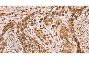 Immunohistochemistry of paraffin-embedded Human esophagus cancer using HIF1AN Polyclonal Antibody at dilution of 1:40