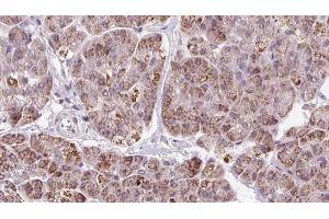 ABIN6273249 at 1/100 staining Human pancreas cancer tissue by IHC-P. (GMFG anticorps  (Internal Region))
