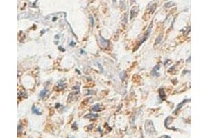Immunohistochemical analysis of paraffin-embedded human lung carcinoma showing cytoplasmic staining with AARSD1 polyclonal antibody  at a 1 : 100 dilution. (AARSD1 anticorps  (AA 278-522))